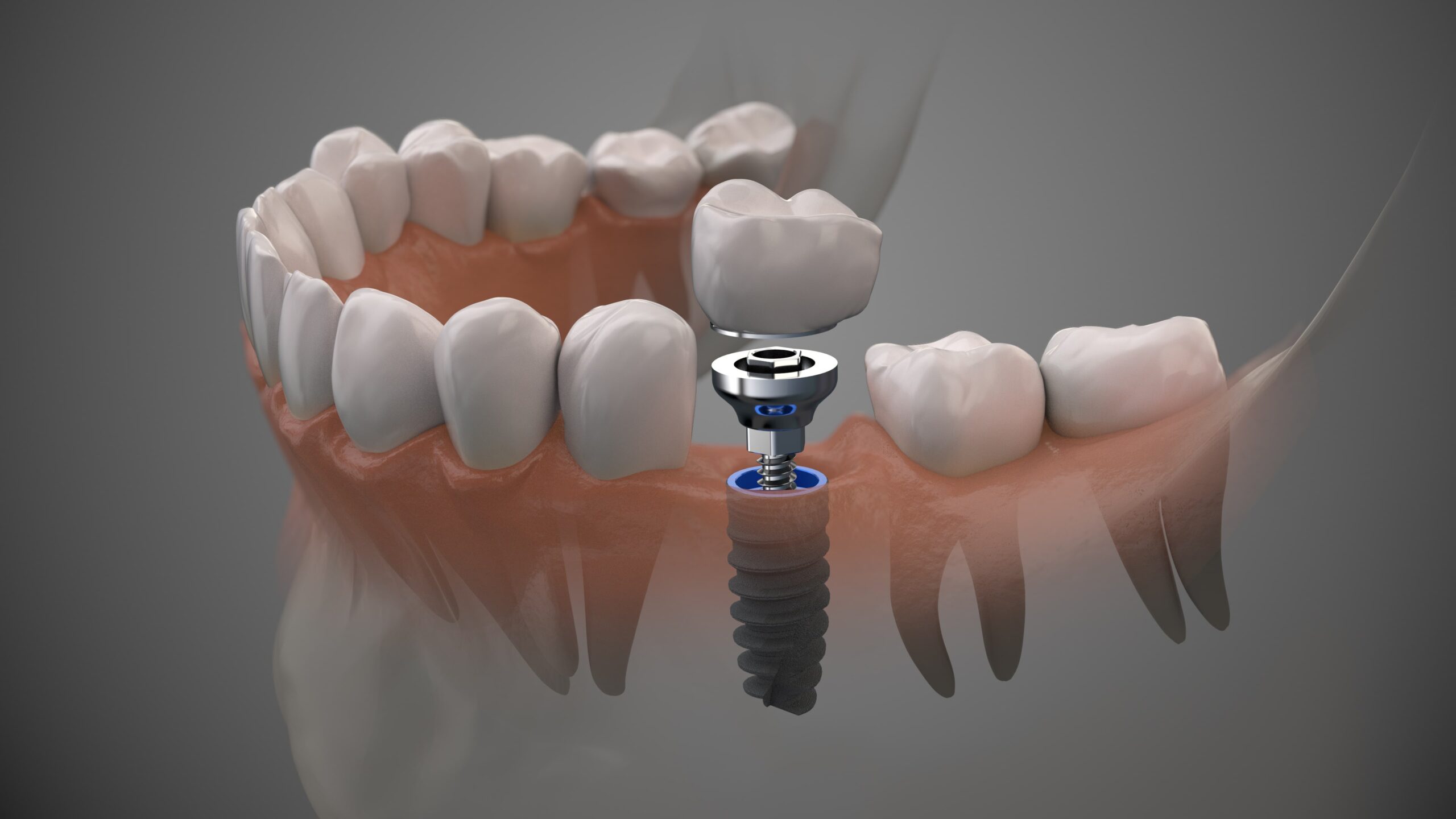 The “Nuts and Bolts” of Implants – What Are They?