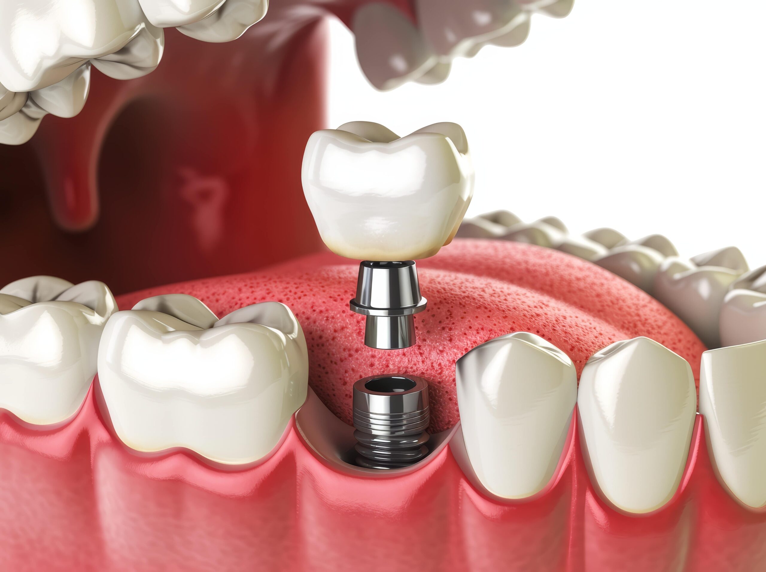 Caring for Dental Implants: Tips and Tricks to Keep Your Smile Shining Bright!