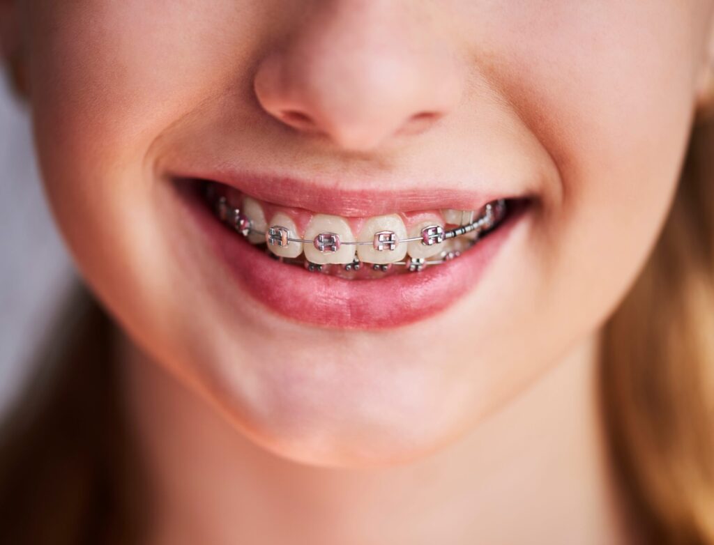 What to Expect After Getting Your Braces Removed