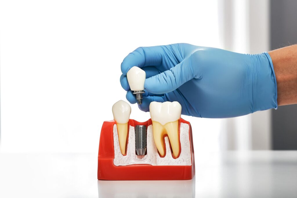 What Are Dental Implants and Why Are They Worth the Investment?