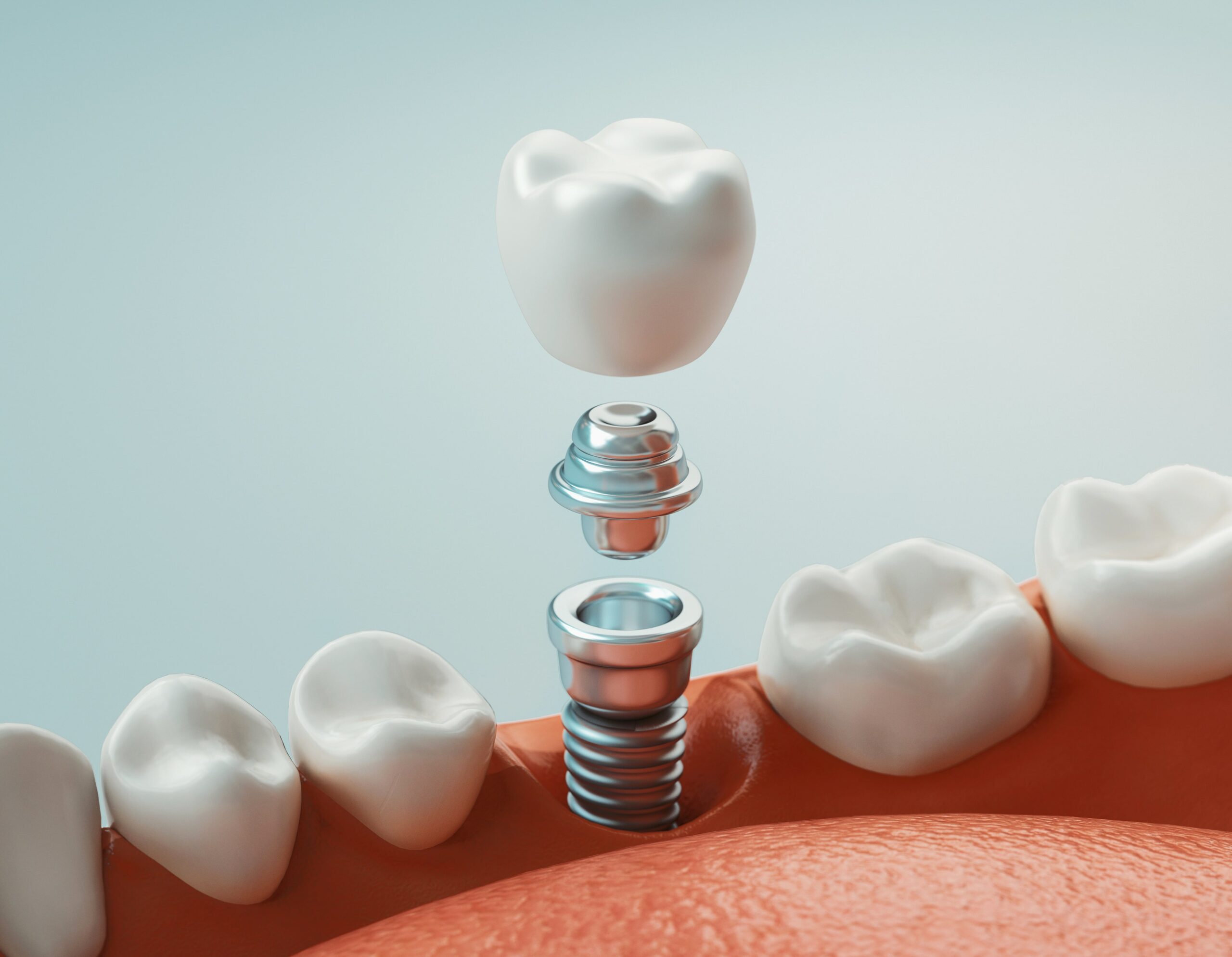 What To Know Before Your Dental Implant Procedure