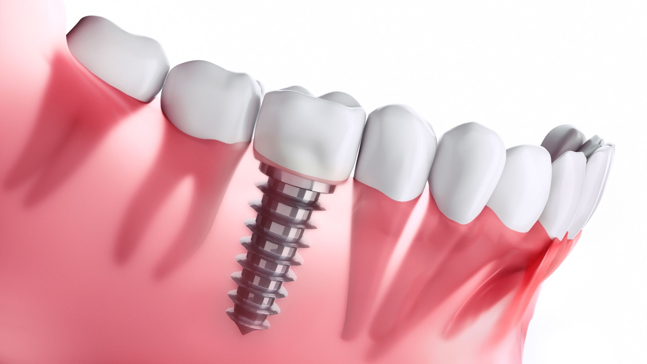 Read more about the article What To Know Before Your Dental Implant Procedure