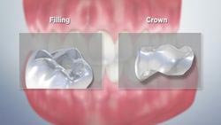 Filling vs. Crown