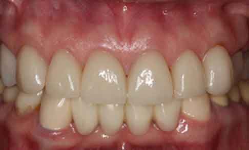 smile makeover results at apex dental group