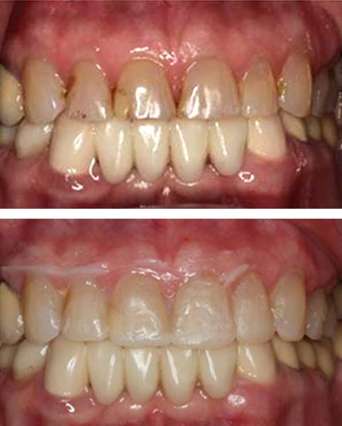 Patient with trial smile coverings at Apex Dental Group