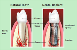 dental implant tooth in Apex
