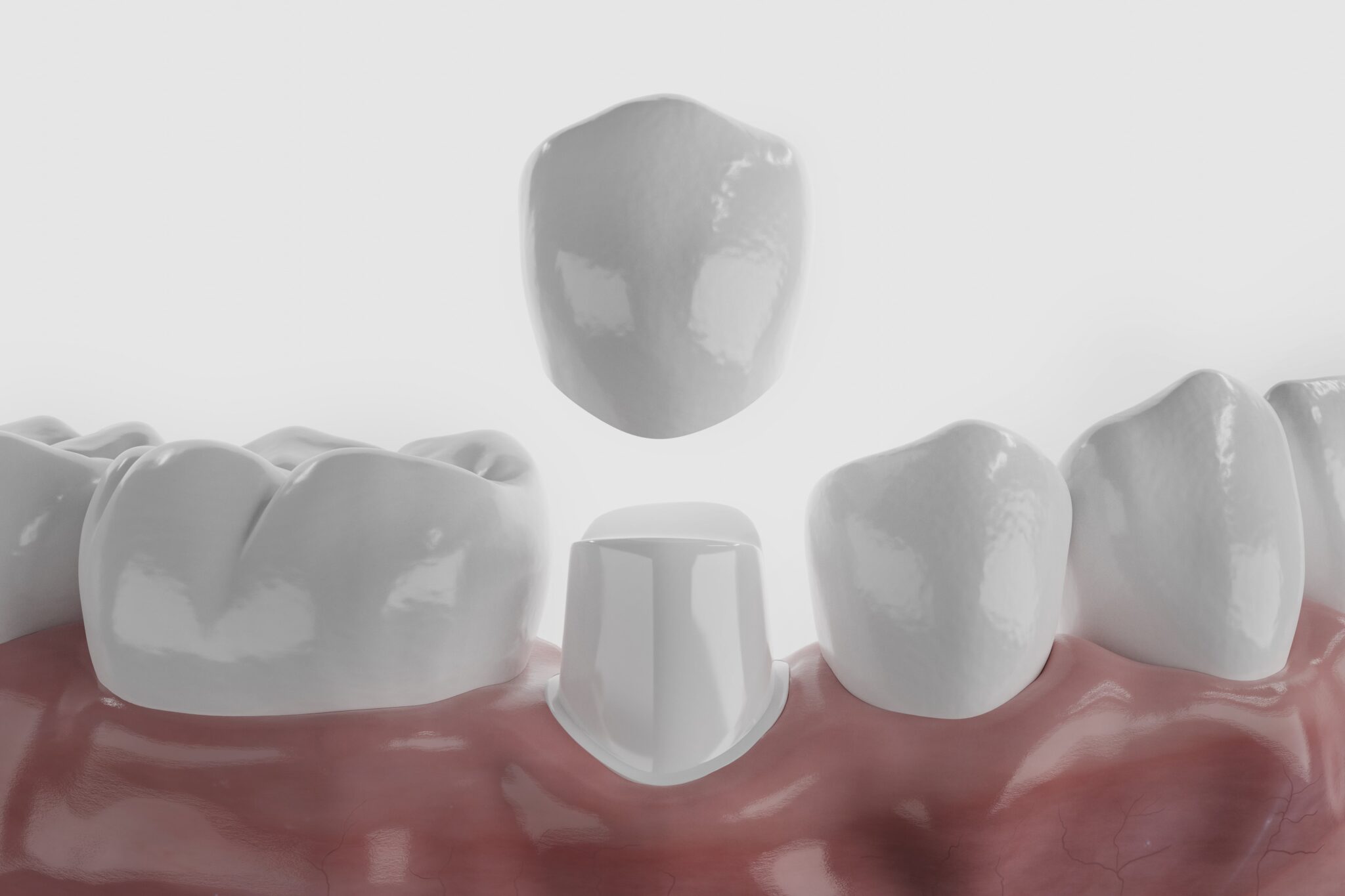 How To Care For Your CEREC Crown For Long-Lasting Results