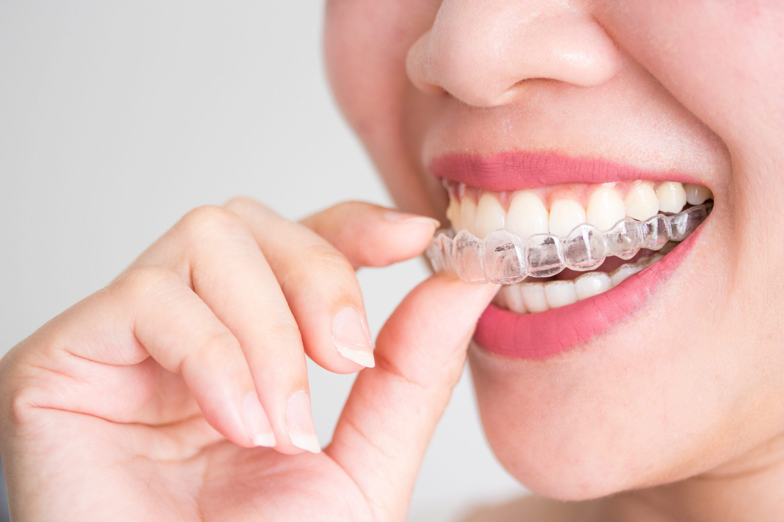 Invisible Braces vs Traditional Braces: Which Is Better for Adults?