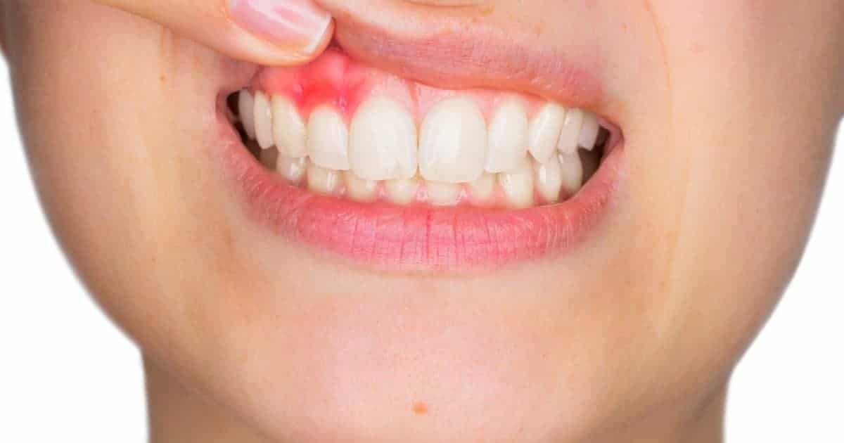 Signs of a Dental Abscess and When to Seek Emergency Care in Apex, NC