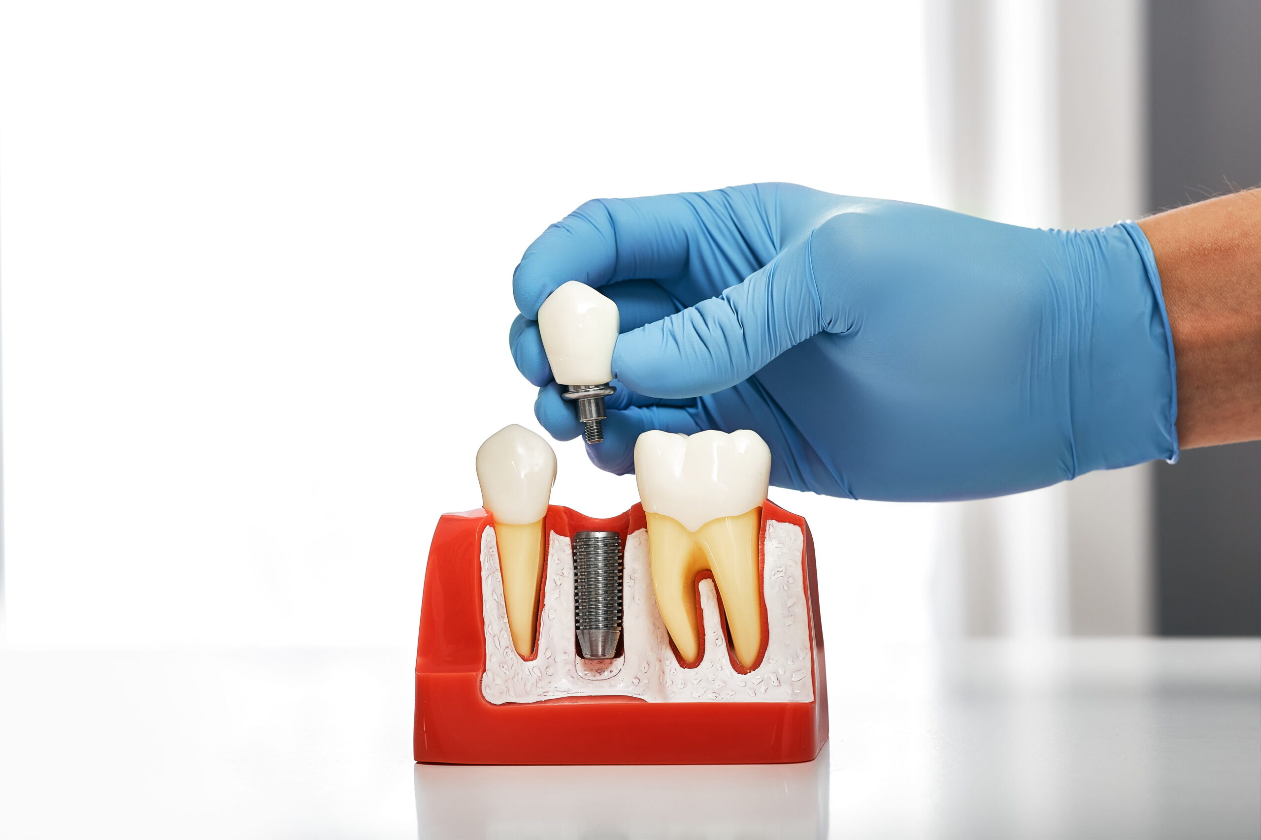 Five Reasons Why Patients Choose Dental Implants As Their Tooth Replacement Option