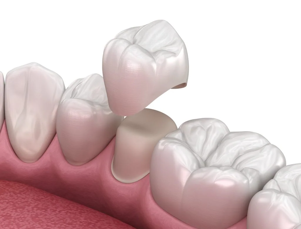 Are Same-Day Crowns as Good as Traditional Crowns?