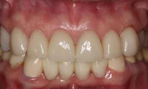 Smile Design Teeth After Smile Design Apex