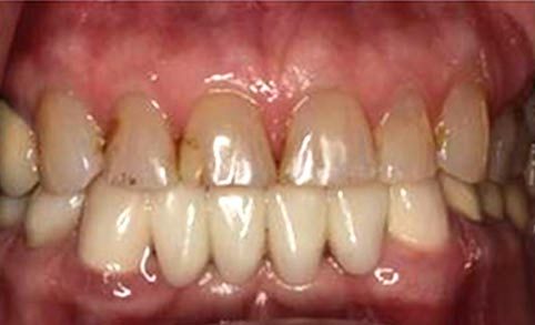 Actual Smile before Smile Design Apex Dental Group